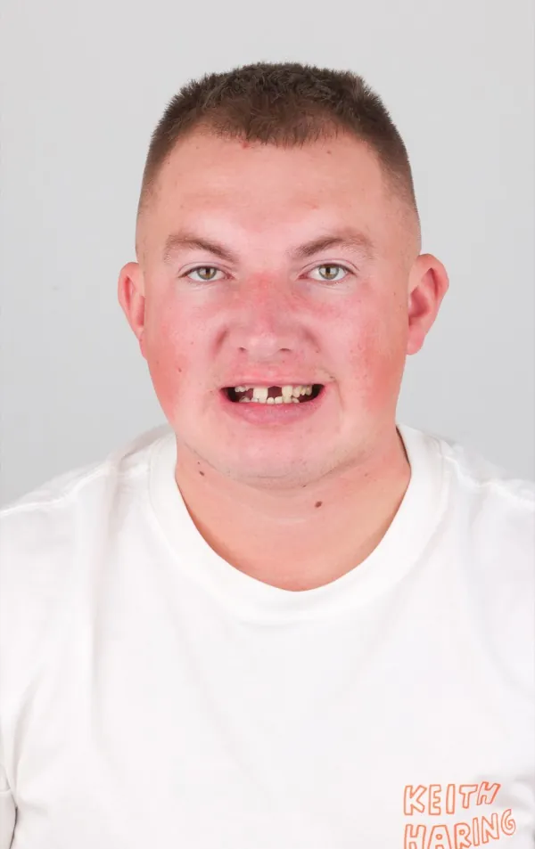 Before dental treatment, Patient 1