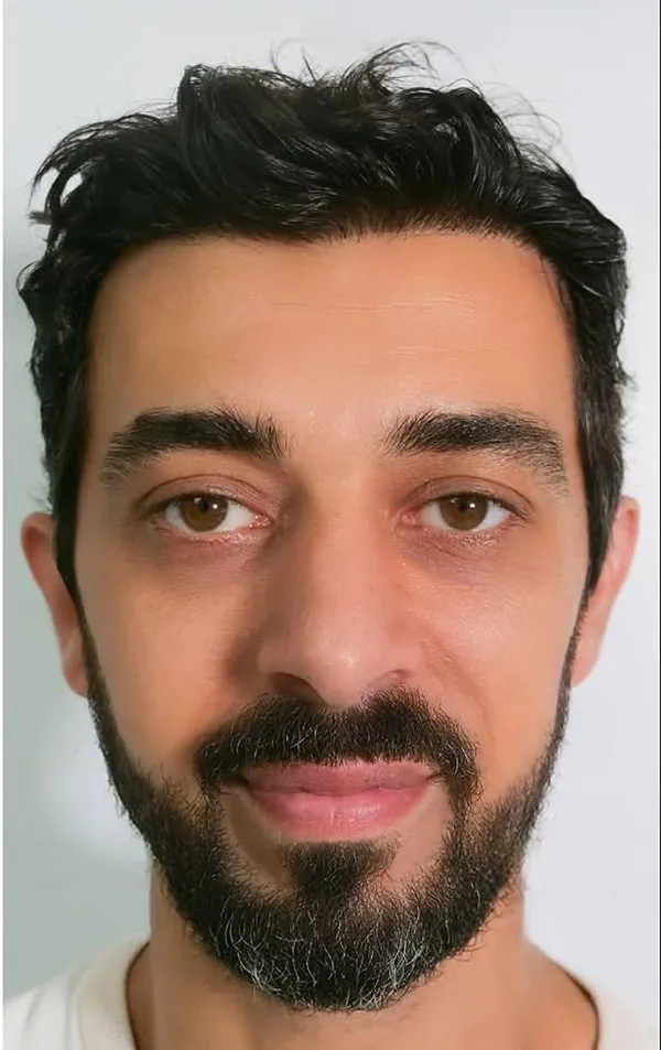 After hair transplant, James