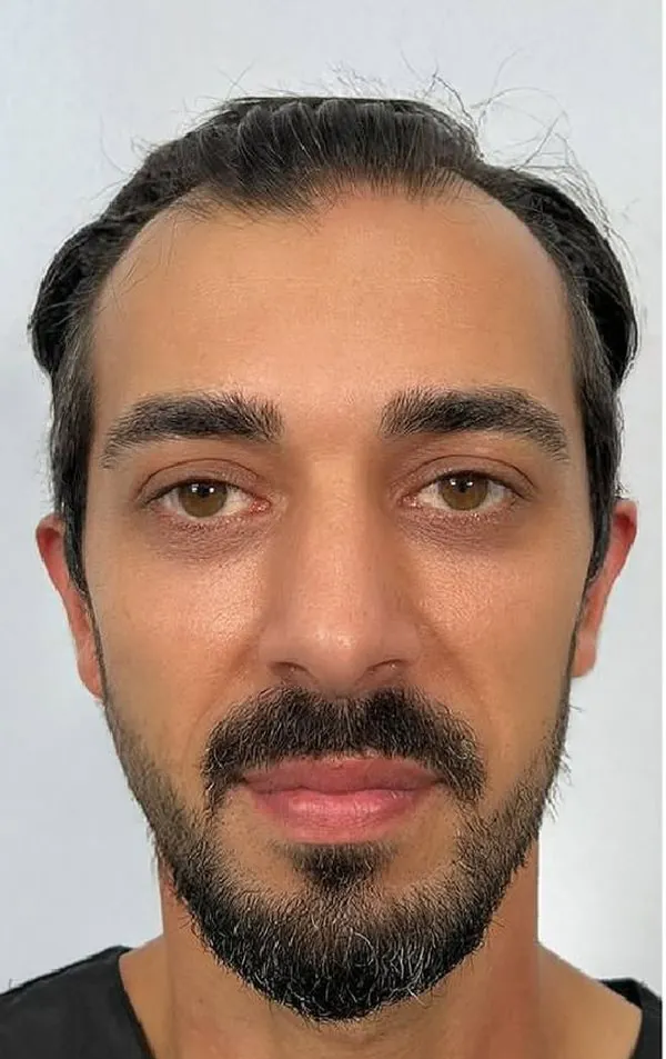 Before hair transplant, James