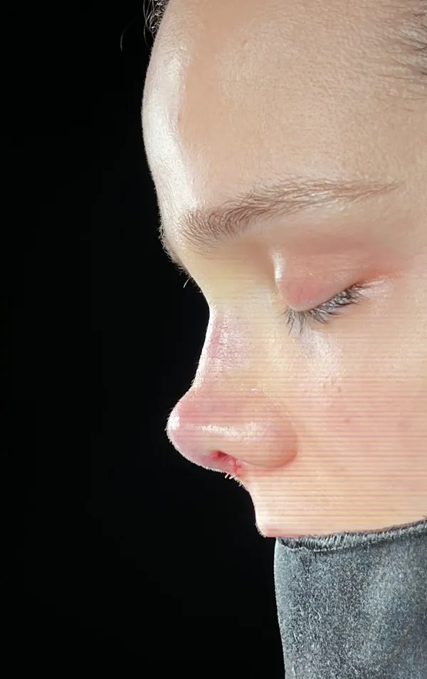 After rhinoplasty, Patient B